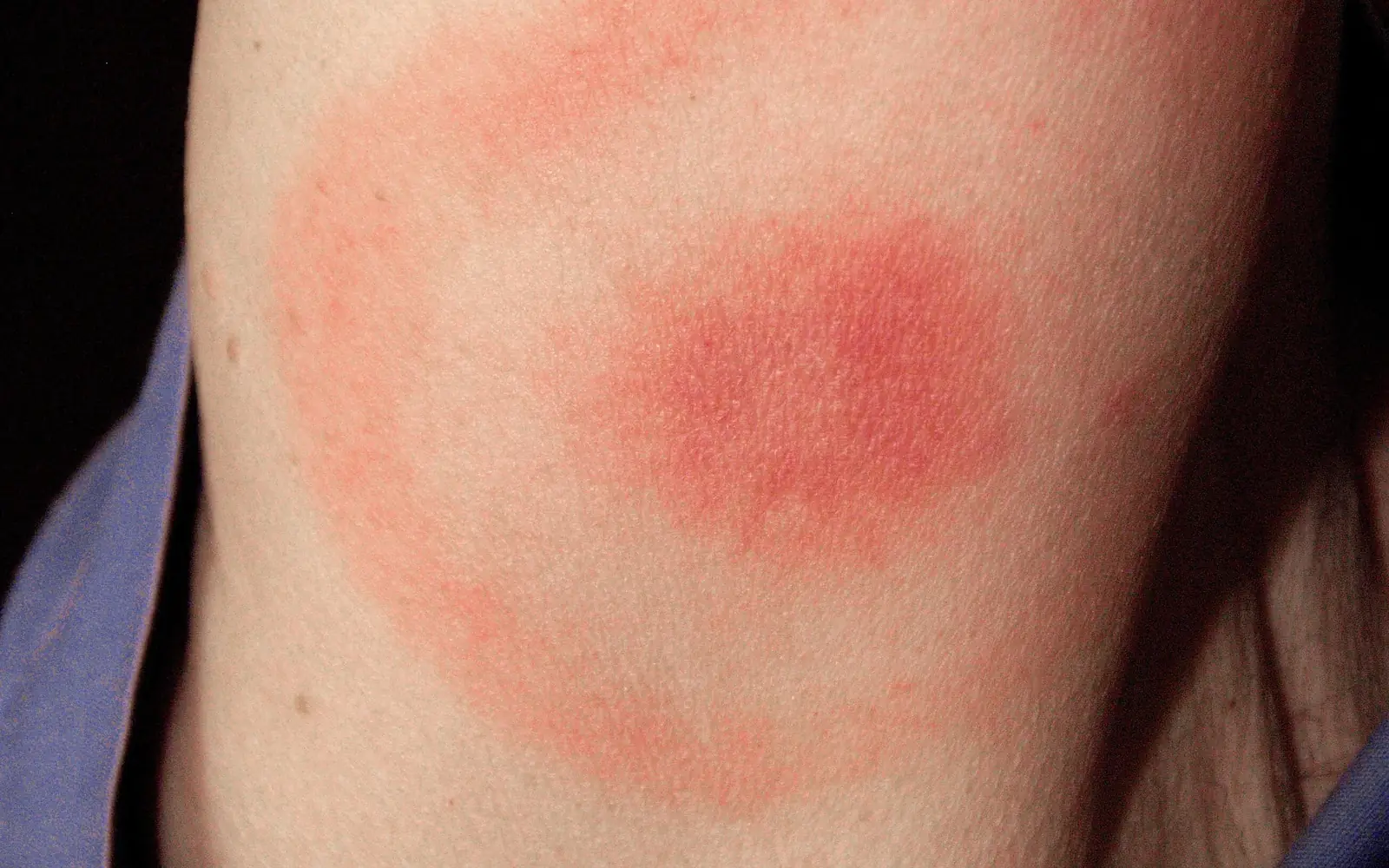 A red rash on the back of an upper arm in a target pattern, with a solid red center, a paler ring around it and a wide red outer ring